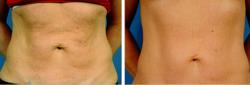 Tummy tuck